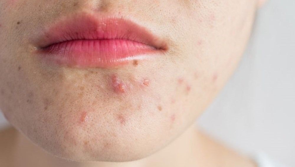 Sivilceye karşı aşı yolda